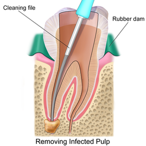 Root Canal Therapy-Always Genial Dental, Langhorne PA